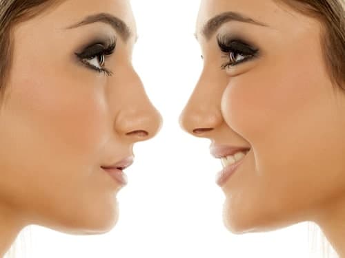 رینوپلاستی چیست و چه کسانی کاندیدای مناسب جراحی بینی هستند؟